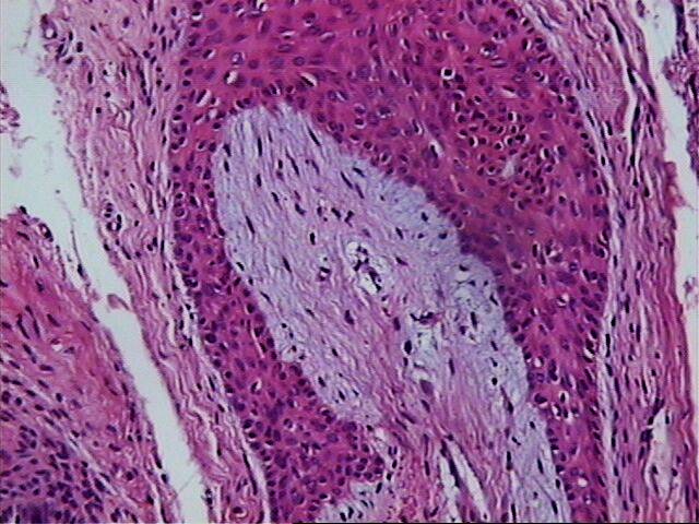 Fig.5 Mucinosis en MF - <div style=